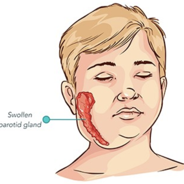 Wasatch County Health Dept has identified a suspected case of mumps in a fully-immunized student